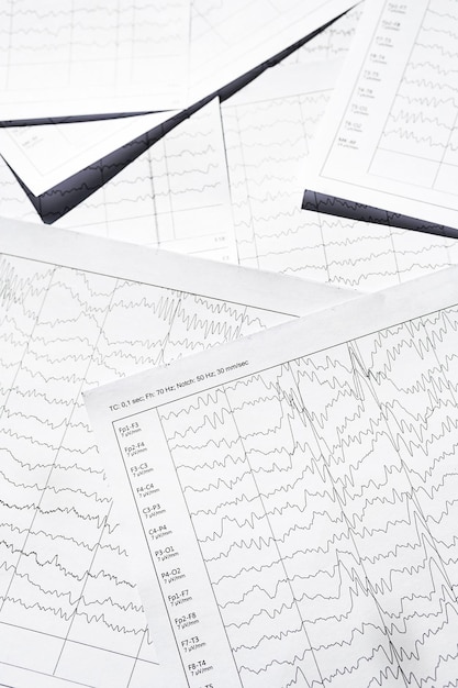 ECG waveforms